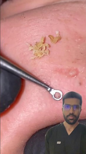 Comedone extraction #comedones #pimplepopping #acne #acnetreatment #skintreatment