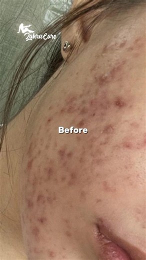 Affordable Face Masks for Acne & Pimples💖 #shorts
