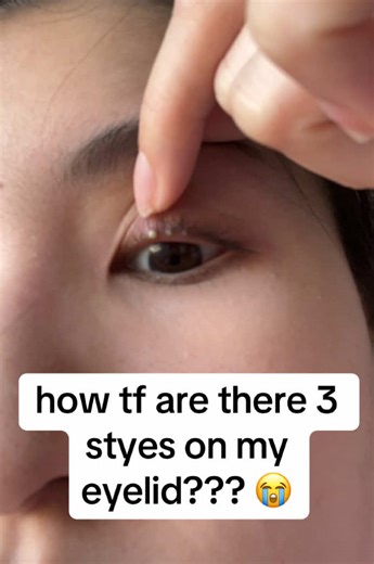 How to make it go away pls help I’m in pain 😭😭😭#stye #allergy#eye | stye on eyelid