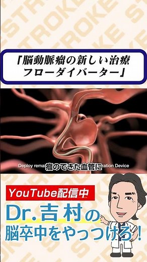 脳動脈瘤の新しい治療 フローダイバーター #脳卒中 #脳出血 #脳動脈瘤 #フローダイバーター #くも膜下出血 #兵庫医科大学 #医学生 #研修医 #脳外科