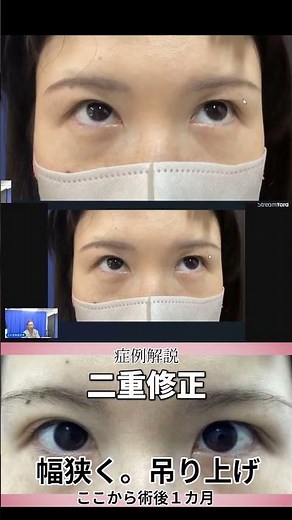 二重瞼修正の症例解説。幅狭く。吊り上げと２本線。手術後1カ月。