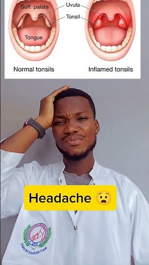 Tonsillitis Warning! Do You Have These Symptoms? | Watch Now! #shorts #tonsilitis #throathealth