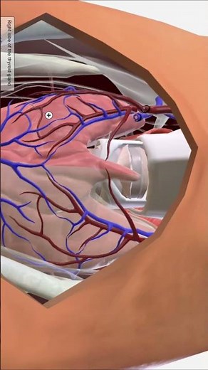 Total Thyroidectomy 3D Animation,Thyroid Surgery Explained,Thyroid Removal Procedure in 60 S