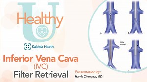13 reactions | Join Dr. Harris Chengazi as he discusses the importance of Inferior Vena Cava (IVC) filter retrieval for this month's Healthy U. Dr. Chengazi also talks about who is a candidate for IVC filters, the risks of leaving them in for too long and more. #HealthyU #IVCFilter #KaleidaHealth | Kaleida Health | Facebook