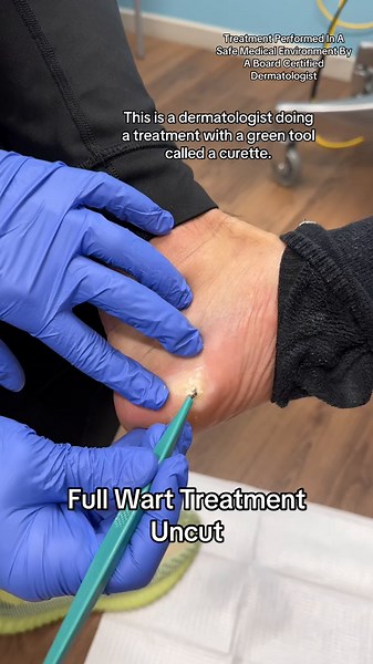 Full Plantar Wart Treatment by Dermatologist