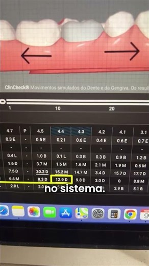 ORTODONTISTA veja este ponto de perigo no Clincheck