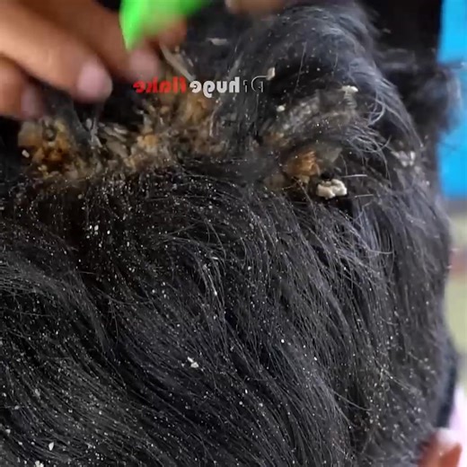 ITCHY DRY SCALP IN FRONT HEAD!! - Scalp Psoriasis And Picking Satisfying Removal 140 Part 7 | Help remove ticks