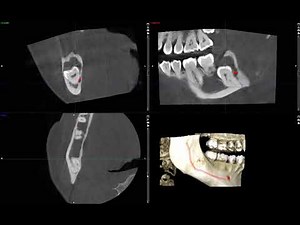 cyst or tumor in the jaw? unknown lesion imaged on CBCT