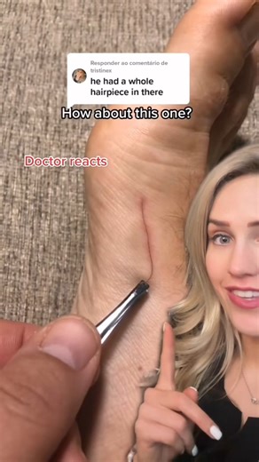 Dr. Dana Figura, DPM on Instagram: "People who work around hair are more at risk (dog groomers, sheep shearers), but hair splinters can occur in anyone who owns an animal! 🎥: cavefaceq on tt #hairsplinter #splinter #splinterremoval #explained"