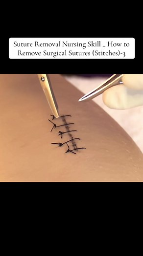 Suture Removal Nursing Skill _ How to Remove Surgical Sutures (Stitches)-3