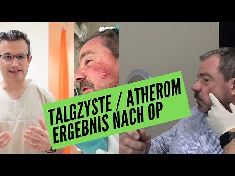 ERFAHRUNGSBERICHT nach ATHEROM-ENTFERNUNG