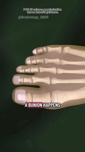 Bunion Correction Surgery | Bunion Osteotomy (3D Animation) #bunionectomy #bunionectomyprocedure #bunioncorrection #bunionsurgery #osteotomysurgery