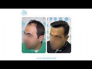 FUE Hair Transplant by Dr. Ibrahim Jebai - Lebanon