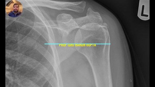Ultrasound guided Barbotage Procedure