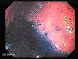 Hyperplastic Polyps - Endoscopy (3 of 14) • Video • MEDtube.net