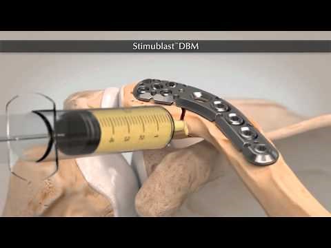 StimuBlast® Demineralized Bone Matrix (DBM)