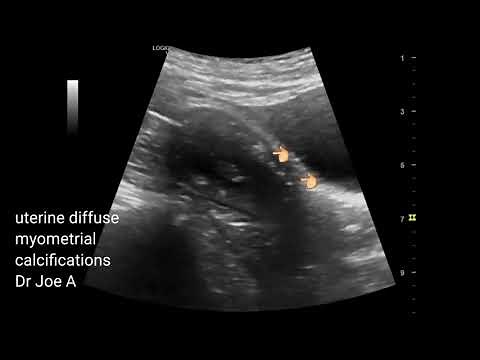 Diffuse uterine myometrial calcifications in post menopausal woman- ultrasound video