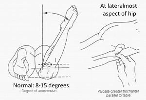 Femoral Anteversion test (Craig's test)
