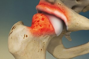 Femoroacetabular impingement (FAI): treatment and recovery