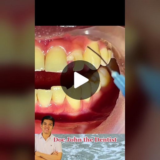 REATREATMENT OF OLD TOOTH FILLING #EDUWOW #learnontiktok #docjohnthedentist #healthtokph #backtotiktokskwela
