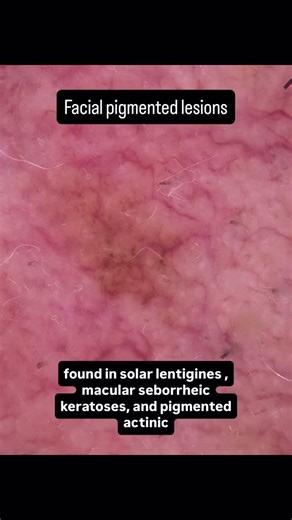 Facial pigmented lesion