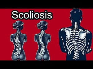 Scoliosis: Causes, Symptoms, and Management Strategies