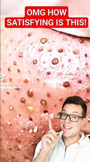 CRAZY GOOD BLACKHEAD REMOVAL - Best Blackheads 2024 #shorts