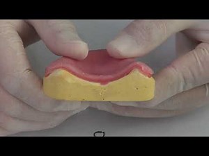 Denture Relining (Rebase)