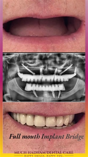 If you’re looking for a long-term solution for missing teeth, a Fixed Implant-Retained Bridge is the ideal choice 💪 ✨ Advantages of an Implant-Retained Bridge: ✔️ Permanent solution – no need to remove it ✔️ Looks and feels like natural teeth 😁 ✔️ Strong biting force – eat with confidence 🍎 ✔️ Helps prevent bone loss 🦴 ✔️ Improved comfort and confidence 😍 😬 Limitations of Flipper Dentures: ❌ Removable and may feel loose ❌ Can cause discomfort while eating ❌ Does not prevent bone loss, whic