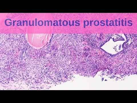 Granulomatous Prostatitis - Pathology mini tutorial