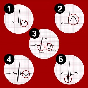 The evolution of a STEMI: even though ischaemia is the first thing that happens, it's not the first change that you will see on the ECG. On a normal ECG, the ST segment is on the baseline. As soon as a patient is experiencing a myocardial infarction, the ST segment will elevate within minutes. For this reason, you will not see the T wave inversion until much later. So, the first sign you will see on your ECG is the ST elevation. As the ST segment comes down within 12-24 hours, the T wave can now