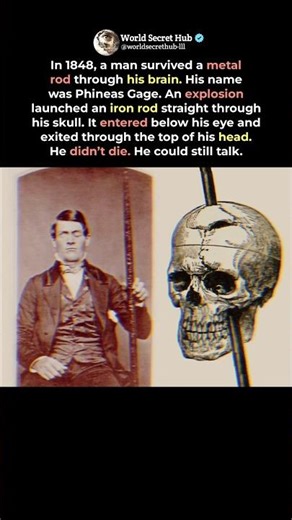 A Hole Through His Brain… He Lived