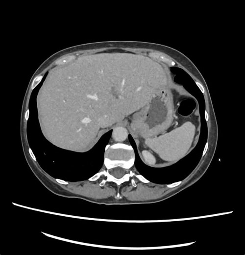 CT enterography.Good technique for diagnosing small bowel abnormalities such as masses, strictures, partial obstruction, Crohn's disease, and celiac disease. The bowel becomes distended through the… | belal soliman