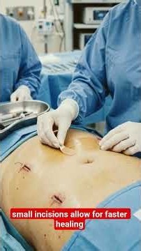 Appendectomy Explained Step by Step | How Appendix Removal Surgery Is Performed
