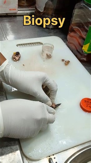 Biopsy sample processing 😞| #histopathology #biopsy #tissuefixation #histomuseum #pathology #anatomy