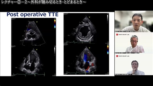 【見逃し配信】2025年9月11日 Moderate大動脈弁逆流＋左室機能低下