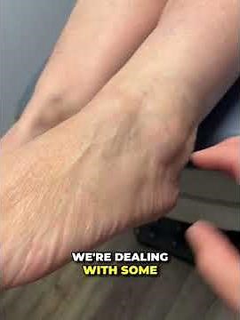 How to Heal an Ankle Fracture Without Surgery