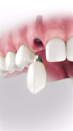 Dental implant placement — from osteotomy to final restoration. 3D animation. #dentist