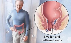 Piles in Men - Problems, Causes, Symptoms and Treatment