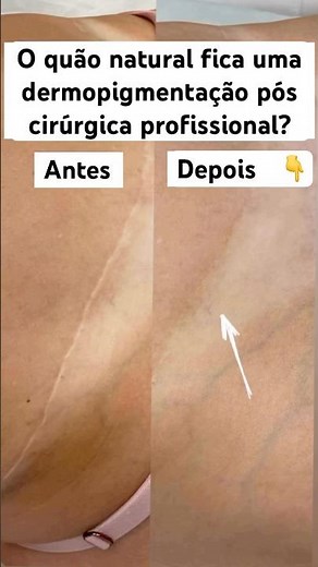 Tatuagem Sobre Cicatriz | Cicatriz Antes e Depois