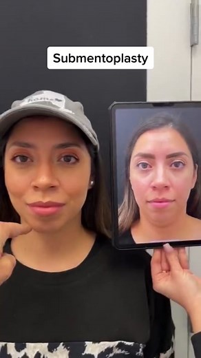 Submentoplasty for Achieving a Defined Jawline