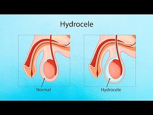 Understanding Hydrocele: Causes, Symptoms, and Treatment Options