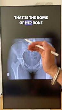 Reading Hip & Pelvis X-Rays Like a Pro! 🩻✅