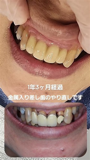 金属入り差し歯のやり直しです。人生をより魅力的にするサポートができていれば嬉しいです#セラミック#ダイヤモンド今井