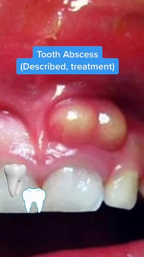 Understanding Tooth Abscess: Causes, Symptoms, and Treatments
