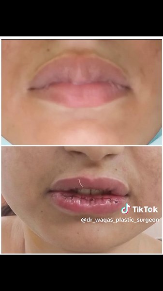 Lip Reduction Surgery Options in Multan