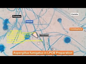 Aspergillus fumigatus growth on SDA and its LPCB Preparation showing conidia, conidiophores, phialid