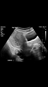 Hydatidiform mole (likely complete mole).