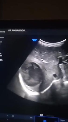 Pyogenic liver abscess. | إستشاري امراض الباطنة والكبد د محمد الجمال