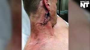 This teen had an e-cigarette explode in his face | NowThis